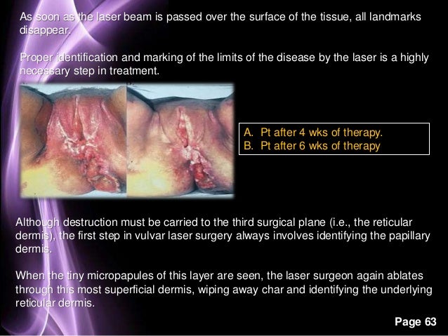 laser ablation of the vulva Slutty blondes cum dick